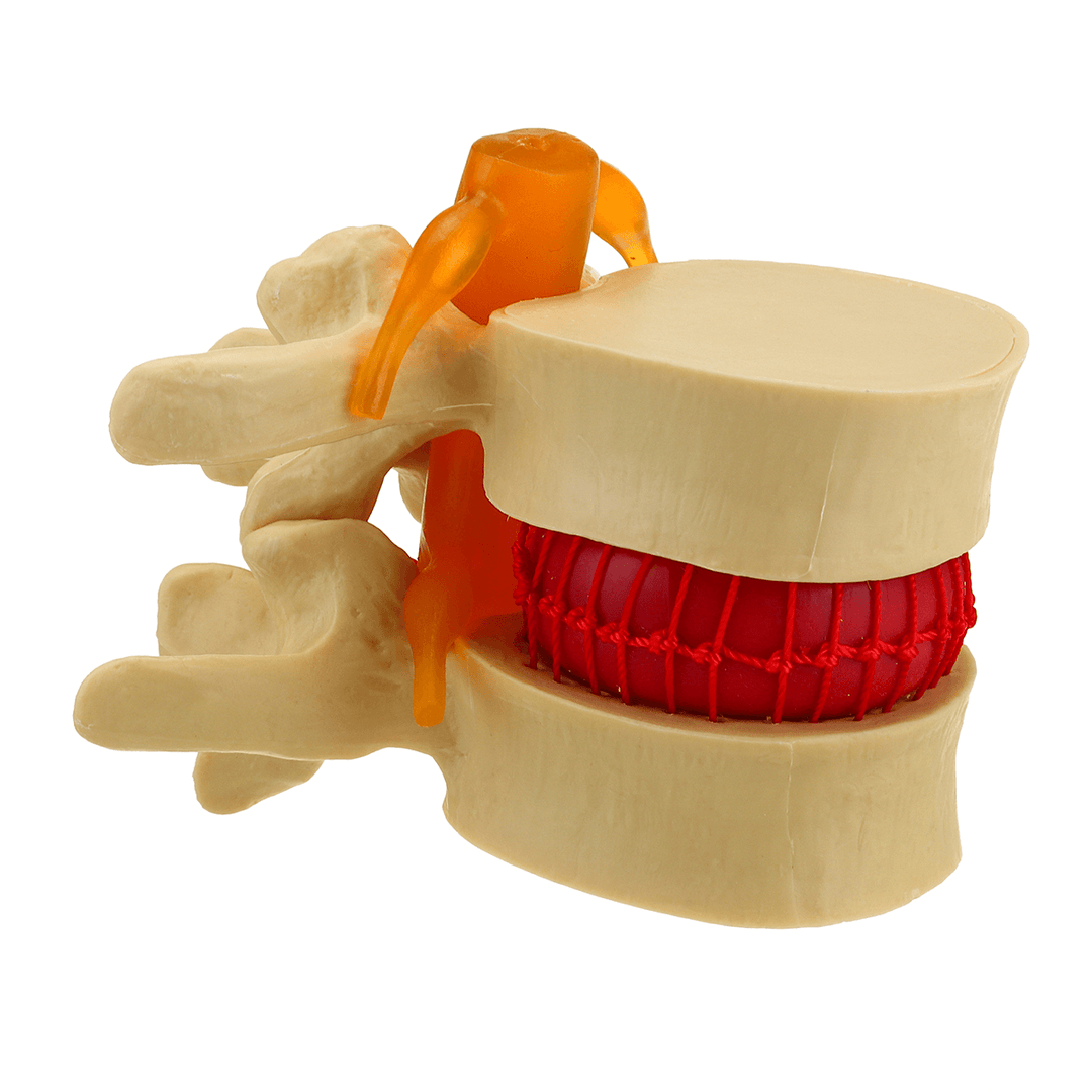 Medical Lumbar Vertebrae Model Props Anatomical Spine Herniation Teaching Tool - MRSLM