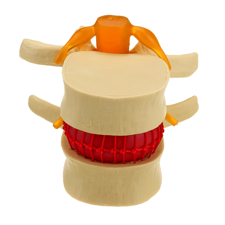 Medical Lumbar Vertebrae Model Props Anatomical Spine Herniation Teaching Tool - MRSLM