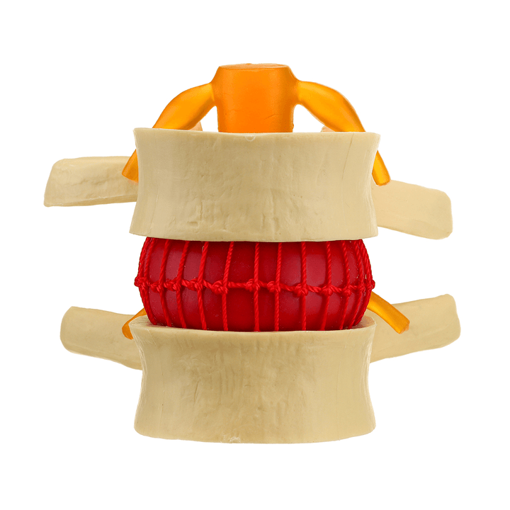 Medical Lumbar Vertebrae Model Props Anatomical Spine Herniation Teaching Tool - MRSLM